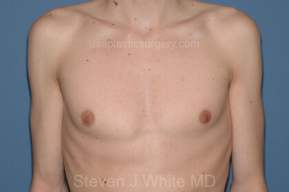 Male Breast Reduction - Gynecomastia Before & After Patient #2363