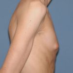 Male Breast Reduction - Gynecomastia Before & After Patient #2363