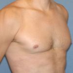Male Breast Reduction - Gynecomastia Before & After Patient #2421