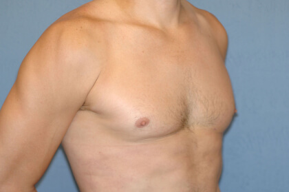 Male Breast Reduction - Gynecomastia Before & After Patient #2421