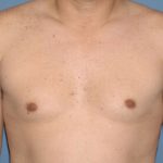 Male Breast Reduction - Gynecomastia Before & After Patient #2422