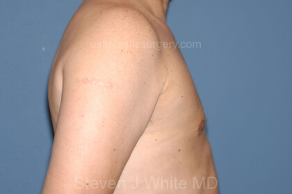 Male Breast Reduction - Gynecomastia Before & After Patient #2422