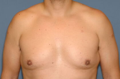 Male Breast Reduction - Gynecomastia Before & After Patient #2423