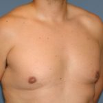 Male Breast Reduction - Gynecomastia Before & After Patient #2423