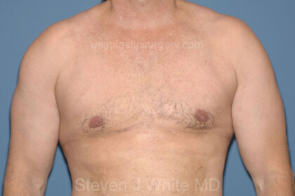 Male Breast Reduction - Gynecomastia Before & After Patient #2424