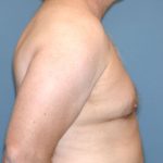 Male Breast Reduction - Gynecomastia Before & After Patient #2424