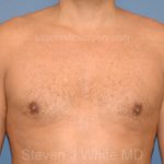 Male Breast Reduction - Gynecomastia Before & After Patient #2425