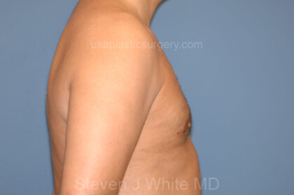 Male Breast Reduction - Gynecomastia Before & After Patient #2425
