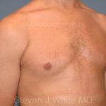 Male Breast Reduction - Gynecomastia Before & After Patient #2426