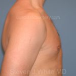 Male Breast Reduction - Gynecomastia Before & After Patient #2426