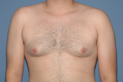 Male Breast Reduction - Gynecomastia Before & After Patient #2427