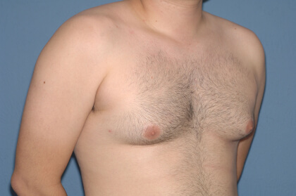 Male Breast Reduction - Gynecomastia Before & After Patient #2427