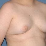Male Breast Reduction - Gynecomastia Before & After Patient #2287