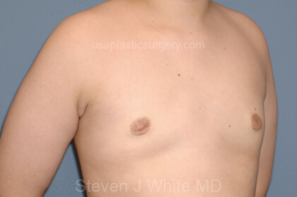 Male Breast Reduction - Gynecomastia Before & After Patient #2287