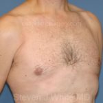 Male Breast Reduction - Gynecomastia Before & After Patient #2428
