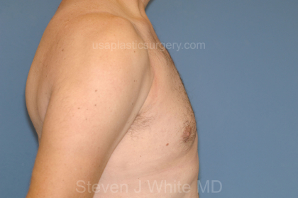 Male Breast Reduction - Gynecomastia Before & After Patient #2428