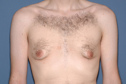 Male Breast Reduction - Gynecomastia Before & After Patient #2477