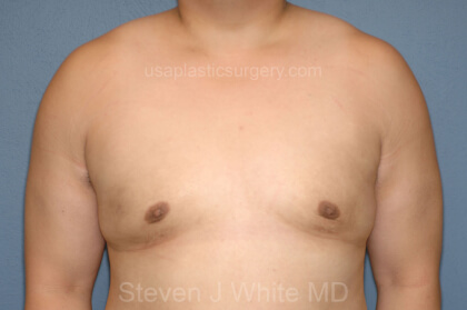 Male Breast Reduction - Gynecomastia Before & After Patient #2478