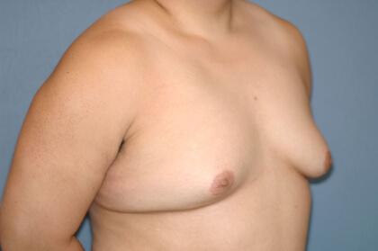 Male Breast Reduction - Gynecomastia Before & After Patient #2478