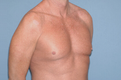 Male Breast Reduction - Gynecomastia Before & After Patient #2479