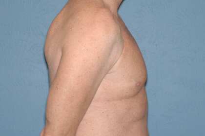 Male Breast Reduction - Gynecomastia Before & After Patient #2479
