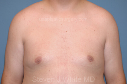 Male Breast Reduction - Gynecomastia Before & After Patient #2480
