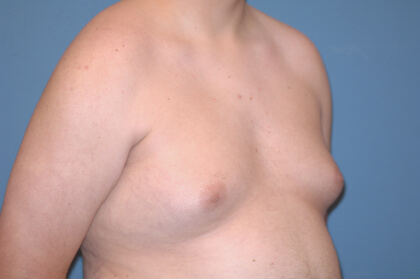 Male Breast Reduction - Gynecomastia Before & After Patient #2480