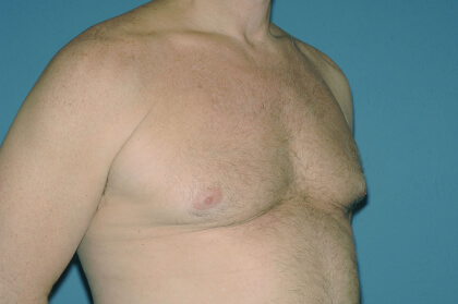 Male Breast Reduction - Gynecomastia Before & After Patient #2481
