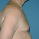 Male Breast Reduction - Gynecomastia Before & After Patient #2481