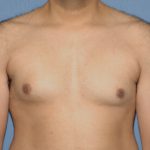 Male Breast Reduction - Gynecomastia Before & After Patient #2482