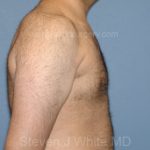 Male Breast Reduction - Gynecomastia Before & After Patient #2482