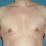 Male Breast Reduction - Gynecomastia Before & After Patient #2483