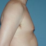 Male Breast Reduction - Gynecomastia Before & After Patient #2483