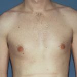 Male Breast Reduction - Gynecomastia Before & After Patient #2484