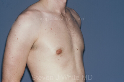 Male Breast Reduction - Gynecomastia Before & After Patient #2484