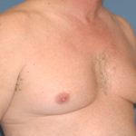 Male Breast Reduction - Gynecomastia Before & After Patient #2485