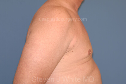 Male Breast Reduction - Gynecomastia Before & After Patient #2485