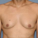 Male Breast Reduction - Gynecomastia Before & After Patient #2486