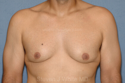 Male Breast Reduction - Gynecomastia Before & After Patient #2486