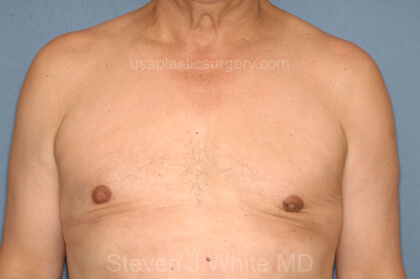 Male Breast Reduction - Gynecomastia Before & After Patient #2487