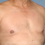 Male Breast Reduction - Gynecomastia Before & After Patient #2487