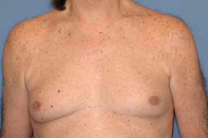 Male Breast Reduction - Gynecomastia Before & After Patient #2488