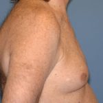 Male Breast Reduction - Gynecomastia Before & After Patient #2488