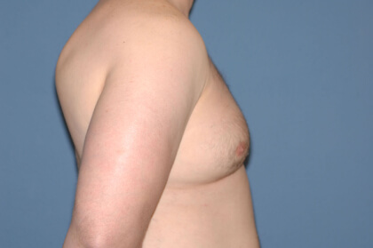 Male Breast Reduction - Gynecomastia Before & After Patient #2289