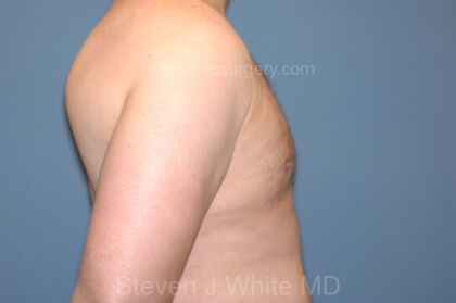 Male Breast Reduction - Gynecomastia Before & After Patient #2289