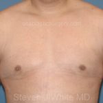 Male Breast Reduction - Gynecomastia Before & After Patient #2290