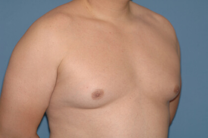 Male Breast Reduction - Gynecomastia Before & After Patient #2290