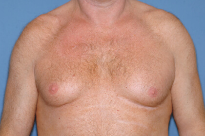 Male Breast Reduction - Gynecomastia Before & After Patient #2291