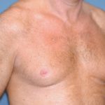 Male Breast Reduction - Gynecomastia Before & After Patient #2291