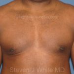 Male Breast Reduction - Gynecomastia Before & After Patient #2292